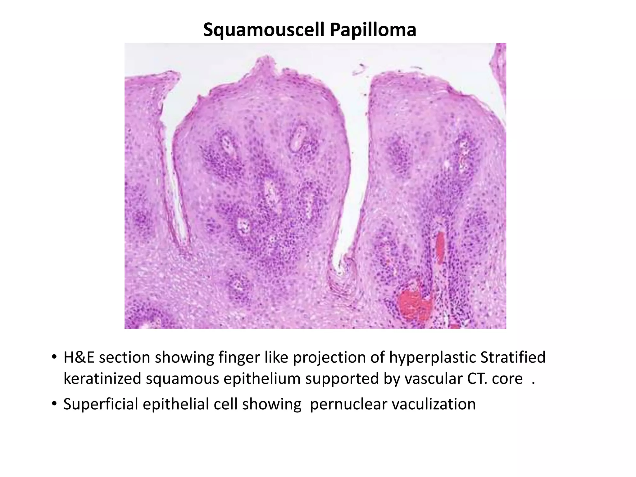 Squamouscell Papilloma




• H&E section showing finger like projection of hyperplastic Stratified
  keratinized squamous epithelium supported by vascular CT. core .
• Superficial epithelial cell showing pernuclear vaculization
 