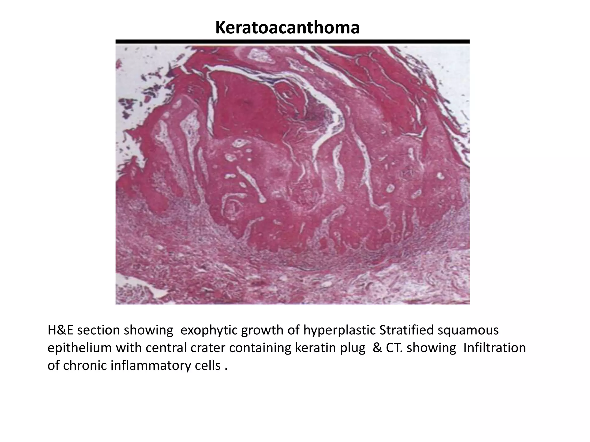 Keratoacanthoma




H&E section showing exophytic growth of hyperplastic Stratified squamous
epithelium with central crater containing keratin plug & CT. showing Infiltration
of chronic inflammatory cells .
 