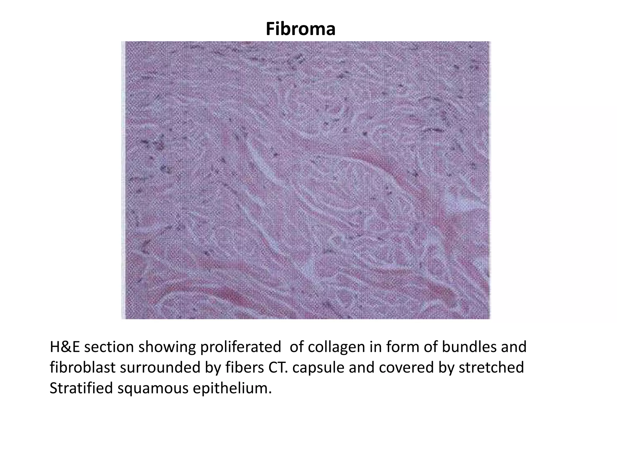 Fibroma




H&E section showing proliferated of collagen in form of bundles and
fibroblast surrounded by fibers CT. capsule and covered by stretched
Stratified squamous epithelium.
 
