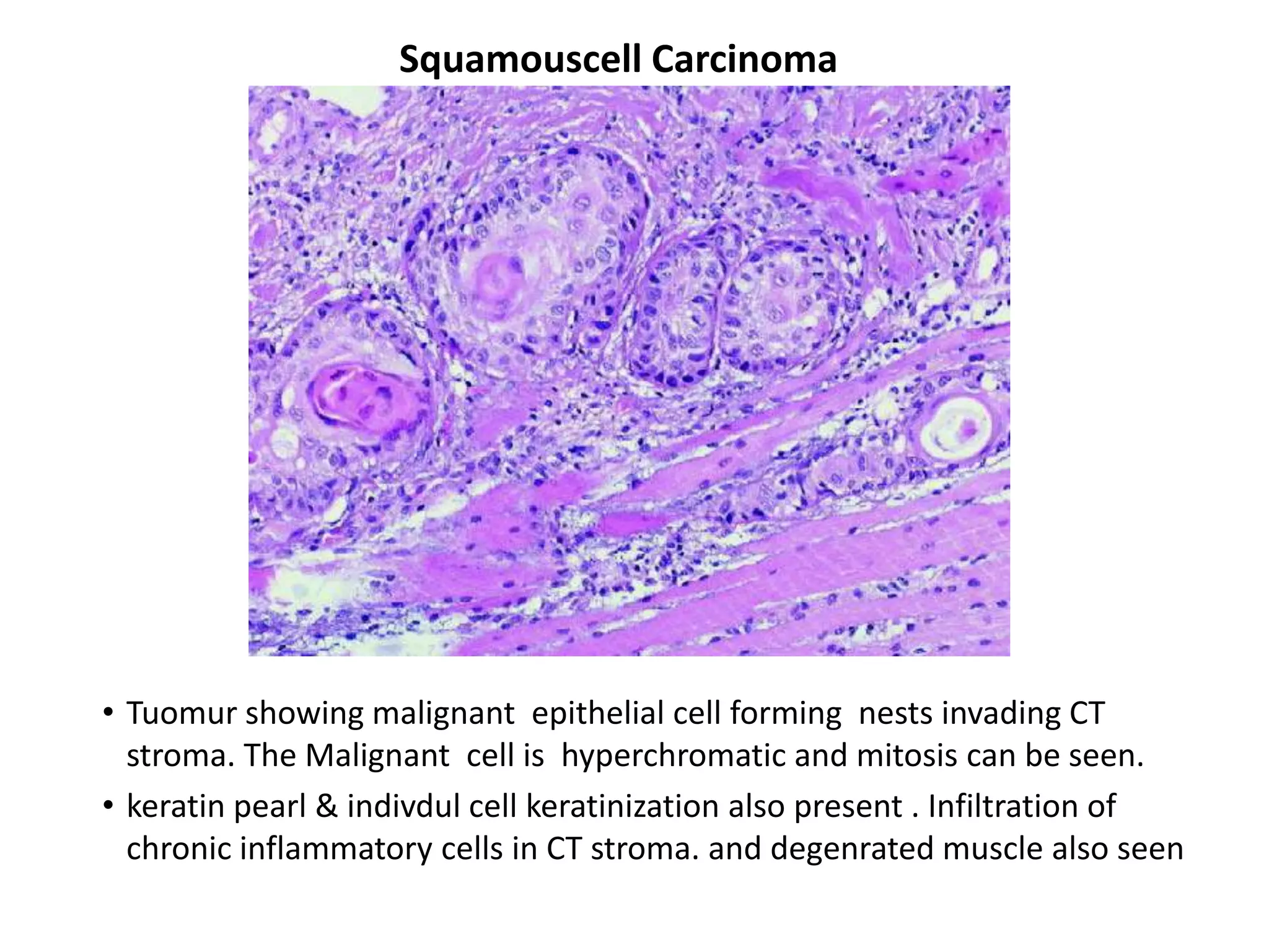 Squamouscell Carcinoma




• Tuomur showing malignant epithelial cell forming nests invading CT
  stroma. The Malignant cell is hyperchromatic and mitosis can be seen.
• keratin pearl & indivdul cell keratinization also present . Infiltration of
  chronic inflammatory cells in CT stroma. and degenrated muscle also seen
 