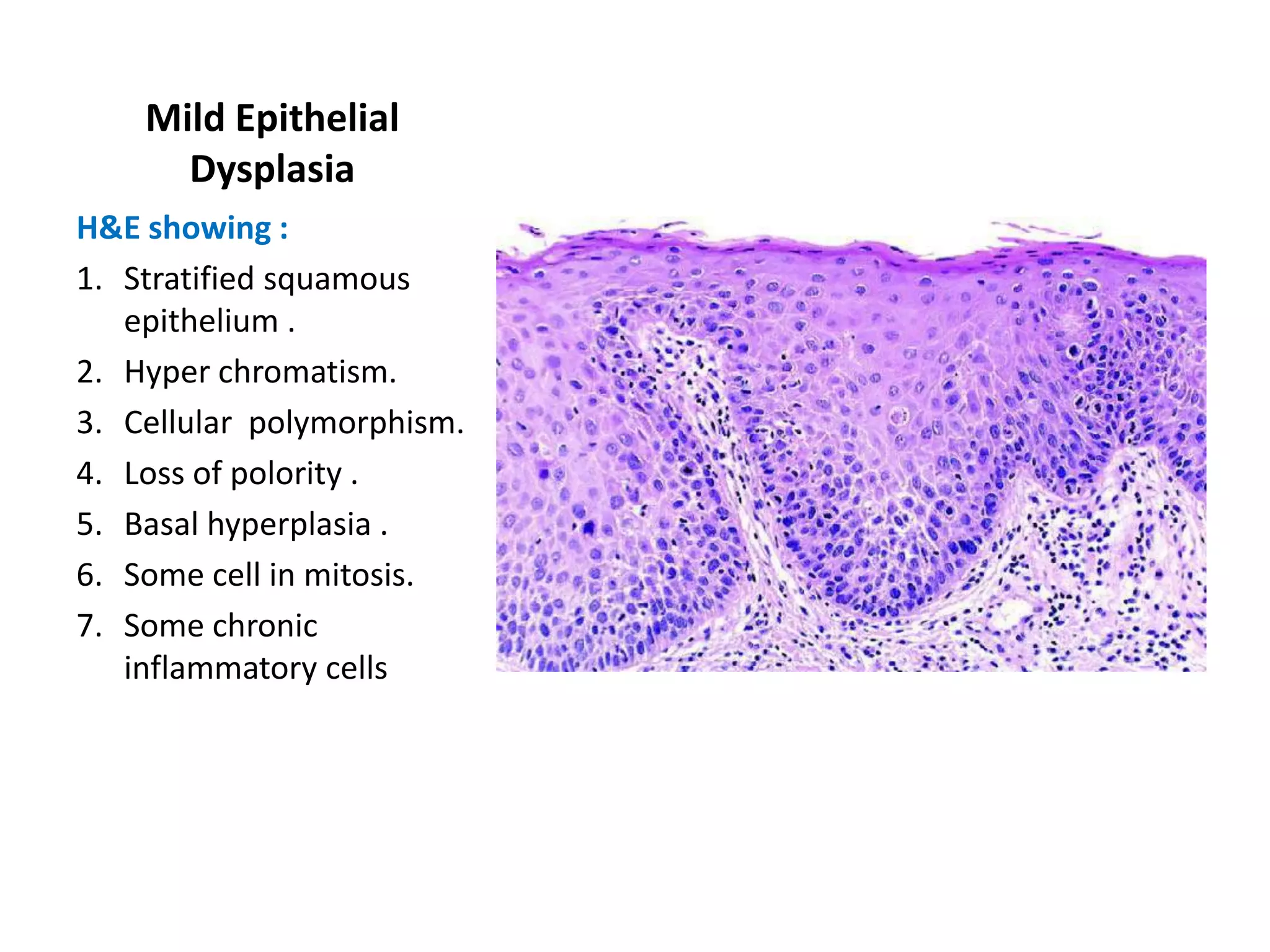 Mild Epithelial
      Dysplasia
H&E showing :
1. Stratified squamous
   epithelium .
2. Hyper chromatism.
3. Cellular polymorphism.
4. Loss of polority .
5. Basal hyperplasia .
6. Some cell in mitosis.
7. Some chronic
   inflammatory cells
 