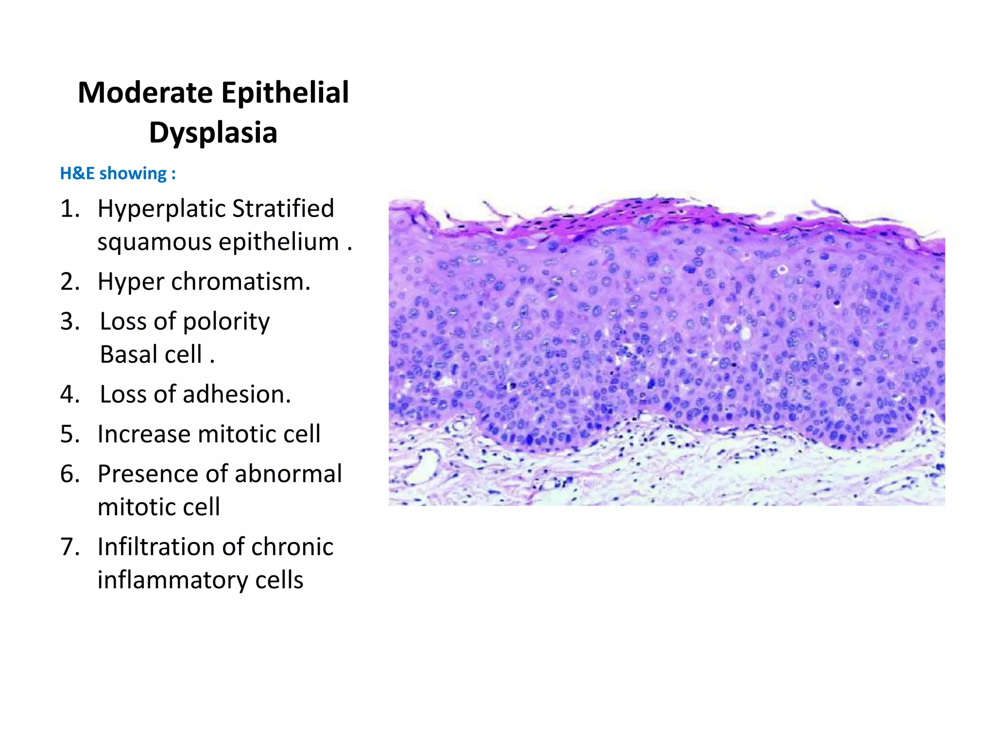 Moderate Epithelial
    Dysplasia
H&E showing :
1. Hyperplatic Stratified
   squamous epithelium .
2. Hyper chromatism.
3. Loss of polority
   Basal cell .
4. Loss of adhesion.
5. Increase mitotic cell
6. Presence of abnormal
   mitotic cell
7. Infiltration of chronic
   inflammatory cells
 