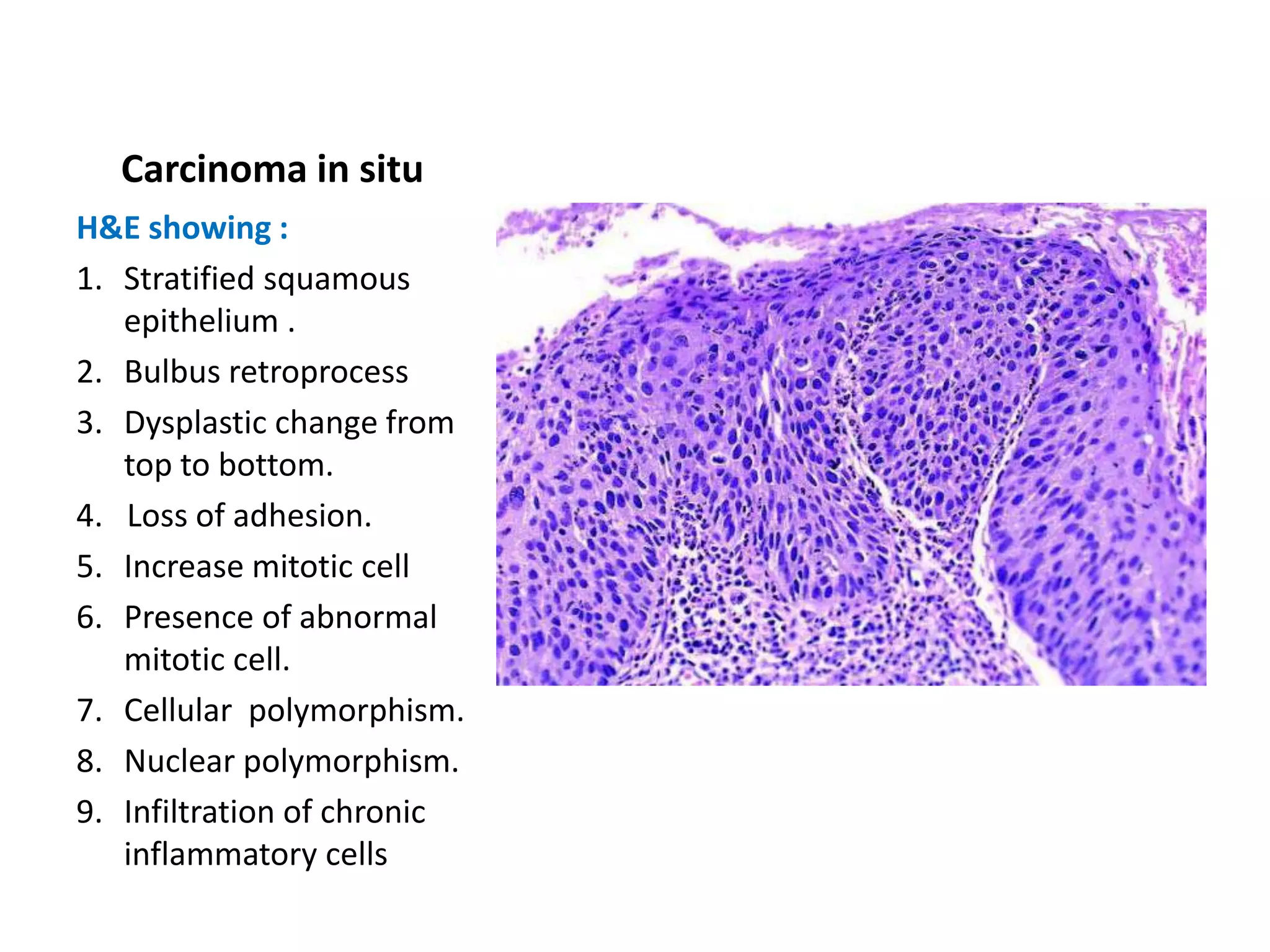 Carcinoma in situ
H&E showing :
1. Stratified squamous
   epithelium .
2. Bulbus retroprocess
3. Dysplastic change from
   top to bottom.
4. Loss of adhesion.
5. Increase mitotic cell
6. Presence of abnormal
   mitotic cell.
7. Cellular polymorphism.
8. Nuclear polymorphism.
9. Infiltration of chronic
   inflammatory cells
 