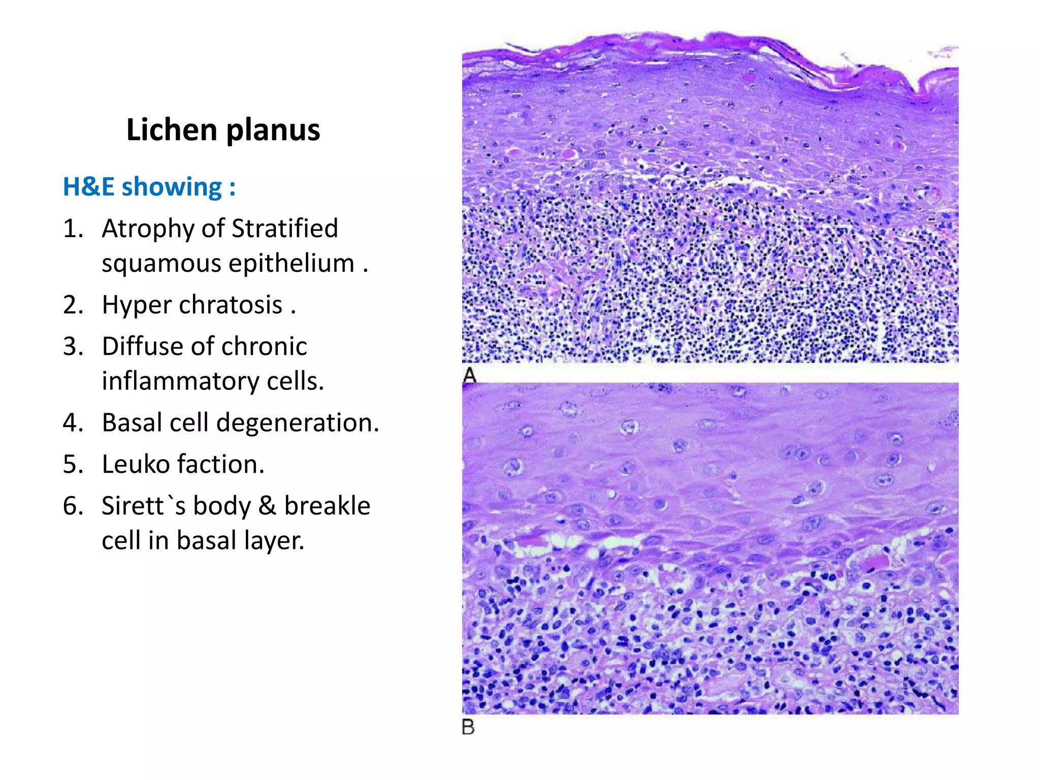 Lichen planus
H&E showing :
1. Atrophy of Stratified
   squamous epithelium .
2. Hyper chratosis .
3. Diffuse of chronic
   inflammatory cells.
4. Basal cell degeneration.
5. Leuko faction.
6. Sirett`s body & breakle
   cell in basal layer.
 