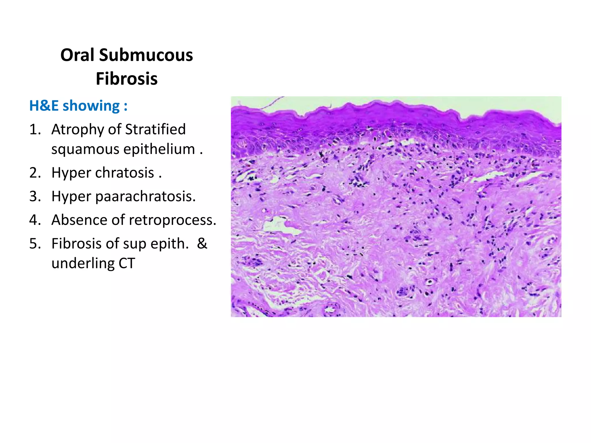 Oral Submucous
        Fibrosis
H&E showing :
1. Atrophy of Stratified
   squamous epithelium .
2. Hyper chratosis .
3. Hyper paarachratosis.
4. Absence of retroprocess.
5. Fibrosis of sup epith. &
   underling CT
 