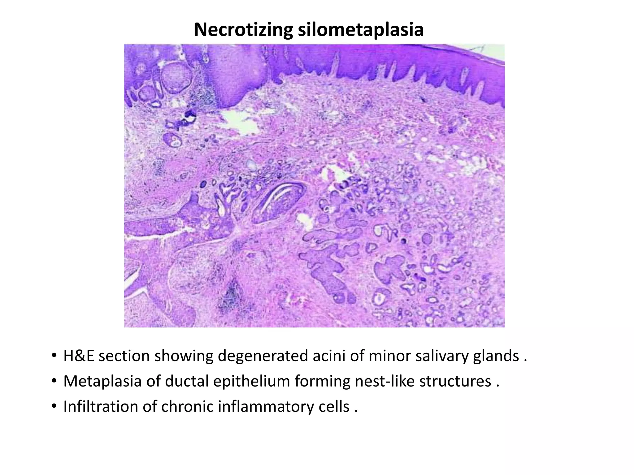 Necrotizing silometaplasia




• H&E section showing degenerated acini of minor salivary glands .
• Metaplasia of ductal epithelium forming nest-like structures .
• Infiltration of chronic inflammatory cells .
 