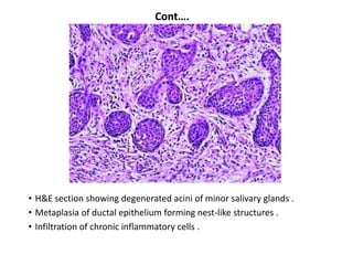 Cont….




• H&E section showing degenerated acini of minor salivary glands .
• Metaplasia of ductal epithelium forming nest-like structures .
• Infiltration of chronic inflammatory cells .
 