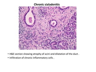 Chronic sialadenitis




• H&E section showing atrophy of acini and dilatation of the duct .
• Infiltration of chronic inflammatory cells .
 