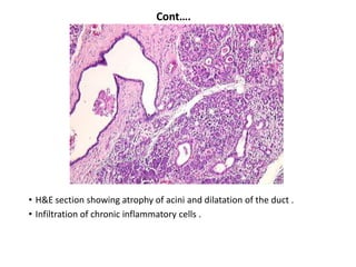 Cont….




• H&E section showing atrophy of acini and dilatation of the duct .
• Infiltration of chronic inflammatory cells .
 