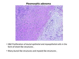 Pleomorphic adenoma




• H&E Proliferation of ductal epithelial and myoepithelial cells in the
  form of sheet-like structures .
• Many ductal-like structures and myxoid-like structures .
 