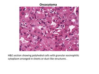 Oncocytoma




H&E section showing polyhedral cells with granular eosinophilic
cytoplasm arranged in sheets or duct-like structures .
 