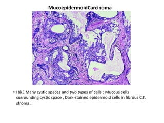 MucoepidermoidCarcinoma




• H&E Many cystic spaces and two types of cells : Mucous cells
  surrounding cystic space , Dark-stained epidermoid cells in fibrous C.T.
  stroma .
 