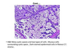 Cont….




• H&E Many cystic spaces and two types of cells : Mucous cells
  surrounding cystic space , Dark-stained epidermoid cells in fibrous C.T.
  stroma .
 