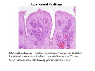 Squamouscell Papilloma




• H&E section showing finger like projection of hyperplastic Stratified
  keratinized squamous epithelium supported by vascular CT. core .
• Superficial epithelial cell showing pernuclear vaculization
 