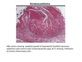 Keratoacanthoma




H&E section showing exophytic growth of hyperplastic Stratified squamous
epithelium with central crater containing keratin plug & CT. showing Infiltration
of chronic inflammatory cells .
 
