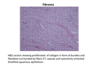 Fibroma




H&E section showing proliferated of collagen in form of bundles and
fibroblast surrounded by fibers CT. capsule and covered by stretched
Stratified squamous epithelium.
 