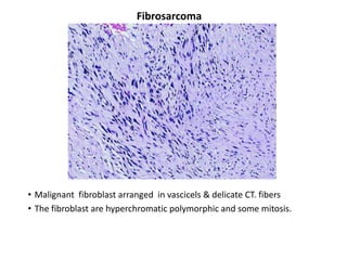 Fibrosarcoma




• Malignant fibroblast arranged in vascicels & delicate CT. fibers
• The fibroblast are hyperchromatic polymorphic and some mitosis.
 