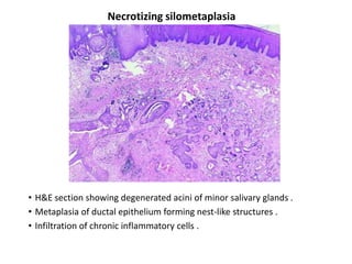 Necrotizing silometaplasia




• H&E section showing degenerated acini of minor salivary glands .
• Metaplasia of ductal epithelium forming nest-like structures .
• Infiltration of chronic inflammatory cells .
 