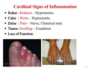 Cardinal Signs of Inflammation
114
 Rubor : Redness – Hyperaemia.
 Calor : Warm – Hyperaemia.
 Dolor : Pain – Nerve, Chemical med.
 Tumor: Swelling – Exudation
 Loss of Function:
2/21/2023
 