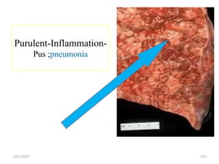 Purulent-Inflammation-
Pus ;pneumonia
119
2/21/2023
 