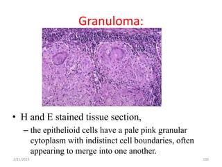 Granuloma:
130
• H and E stained tissue section,
– the epithelioid cells have a pale pink granular
cytoplasm with indistinct cell boundaries, often
appearing to merge into one another.
2/21/2023
 
