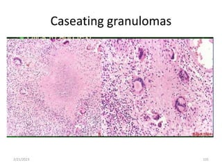 Caseating granulomas
2/21/2023 131
 