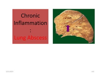 Chronic
Inflammation
:
Lung Abscess
133
2/21/2023
 