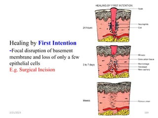 Healing by First Intention
-Focal disruption of basement
membrane and loss of only a few
epithelial cells
E.g. Surgical Incision
169
2/21/2023
 