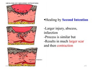 Healing by Second Intention
-Larger injury, abscess,
infarction
-Process is similar but
-Results in much larger scar
and then contraction
173
2/21/2023
 