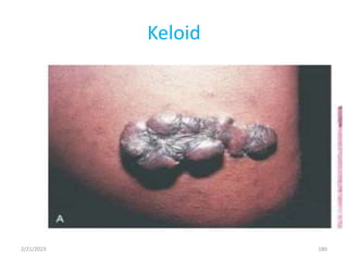 Keloid
180
2/21/2023
 