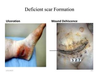 Deficient scar Formation
Ulceration Wound Dehiscence
2/21/2023 181
 