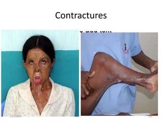 Contractures
2/21/2023 182
 