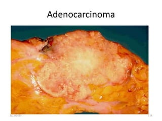 Adenocarcinoma
2/21/2023 216
 