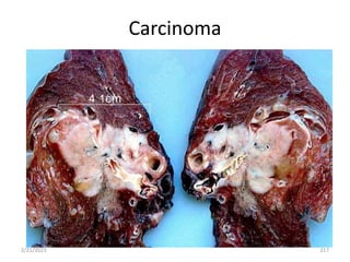 Carcinoma
2/21/2023 217
 