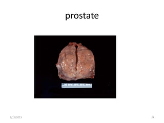 prostate
2/21/2023 24
 