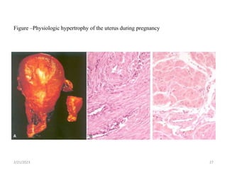 Figure –Physiologic hypertrophy of the uterus during pregnancy
2/21/2023 27
 