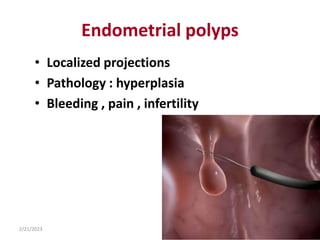 Endometrial polyps
• Localized projections
• Pathology : hyperplasia
• Bleeding , pain , infertility
2/21/2023
277
 