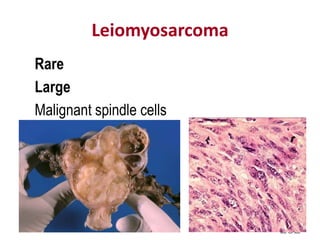Leiomyosarcoma
Rare
Large
Malignant spindle cells
2/21/2023
282
 