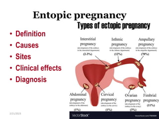 Entopic pregnancy
• Definition
• Causes
• Sites
• Clinical effects
• Diagnosis
2/21/2023
291
 