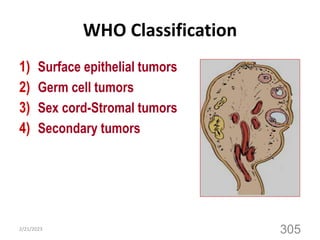 WHO Classification
1) Surface epithelial tumors
2) Germ cell tumors
3) Sex cord-Stromal tumors
4) Secondary tumors
2/21/2023
305
 