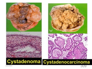 2/21/2023
309
Cystadenoma Cystadenocarcinoma
 