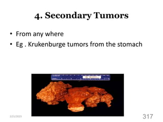 4. Secondary Tumors
• From any where
• Eg . Krukenburge tumors from the stomach
2/21/2023
317
 