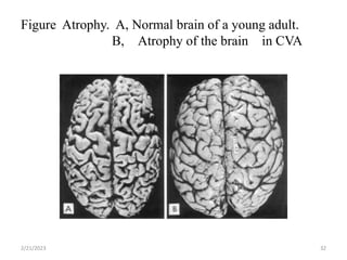 Figure Atrophy. A, Normal brain of a young adult.
B, Atrophy of the brain in CVA
2/21/2023 32
 