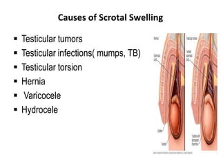 Causes of Scrotal Swelling
 Testicular tumors
 Testicular infections( mumps, TB)
 Testicular torsion
 Hernia
 Varicocele
 Hydrocele
 