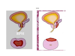 …
BPH Ca Prostate
 