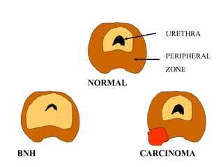 URETHRA
PERIPHERAL
ZONE
NORMAL
BNH CARCINOMA
 