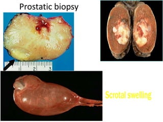 Prostatic biopsy
 