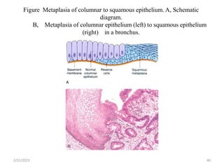 Figure Metaplasia of columnar to squamous epithelium. A, Schematic
diagram.
B, Metaplasia of columnar epithelium (left) to squamous epithelium
(right) in a bronchus.
2/21/2023 40
 