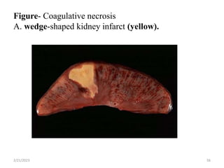 Figure- Coagulative necrosis
A. wedge-shaped kidney infarct (yellow).
2/21/2023 56
 