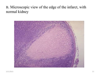 B. Microscopic view of the edge of the infarct, with
normal kidney
2/21/2023 57
 